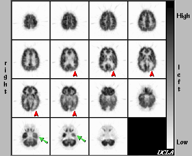 FDG PET scan