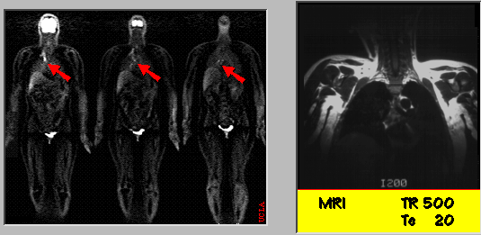 FDG-PET and MRI