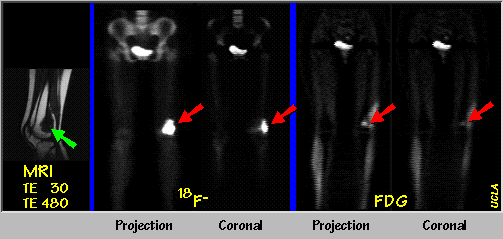 MRI, 18F- and FDG PET scans