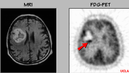 MRI and FDG PET scans