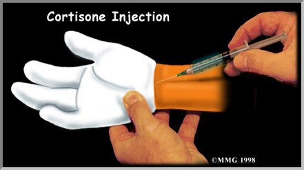 Carpal tunnel steroid injection aftercare