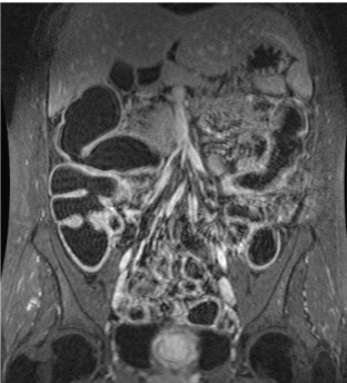 Abdomenal MRI