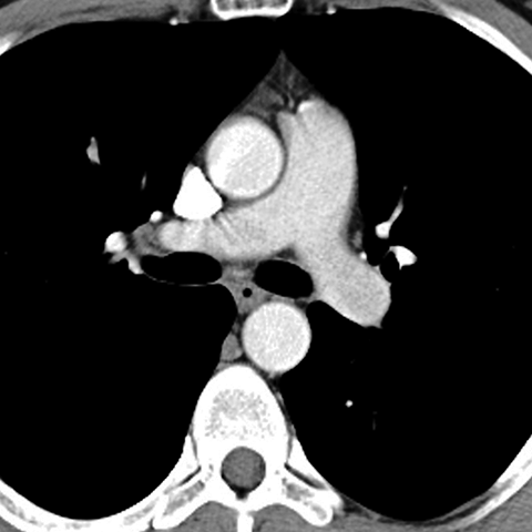 Normal Mediastinum (Axial CT) [4 of 5]