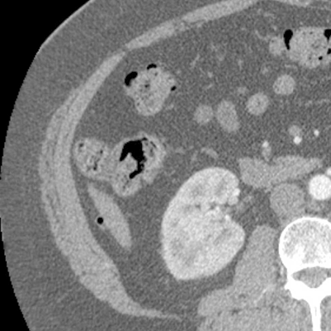 Normal Appendix, CT (axial) [4 of 6]