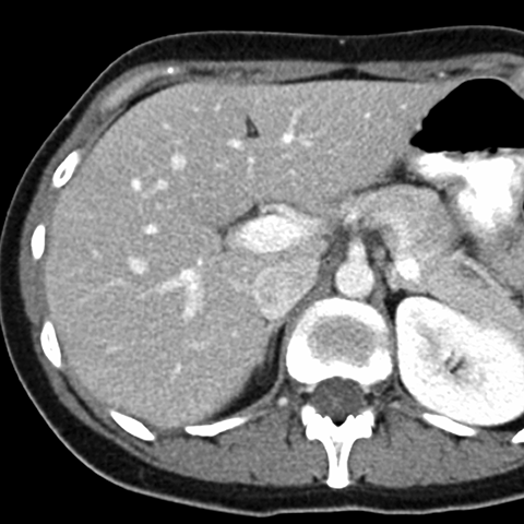 Normal Liver On Ct Scan