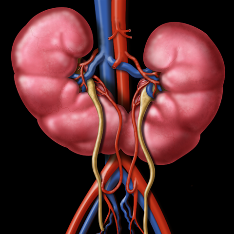 Horseshoe kidney, graphic [1 of 4]