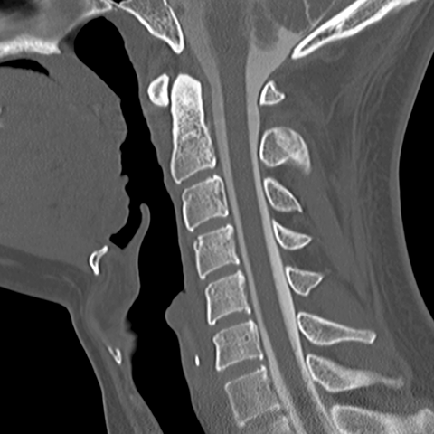 Cervical Spine [7 of 8]