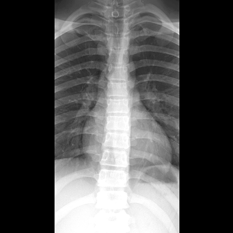 Thoracic spine x-ray