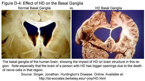 Fig D-4: Effect of HD on the Basal Ganglia