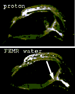 Proton density images of a patient with cartilage damage