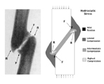 Oblique pseudarthrosis formation. Roentgenogram of an oblique pseudarthrosis. (Adapted from Pauwels F:. Biomechanics of the Locomotor Apparatus. Springer-Verlag, Berlin. p. 124, 1980.) Hydrostatic stress plot from a finite element analysis of compressive forces acting on an oblique fracture site. Fibrocartilage and cartilage formation occur in the interfragmentary gap, a region of hydrostatic compression. Bone formation occurs periosteally in areas of mild hydrostatic tension (marked "F") and bone resorption occurs in areas of high hydrostatic compression (marked "R").