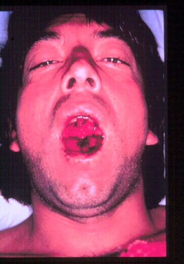 نزيف الفم لدى أحد المصابين بالحمى البوليفية النزفية