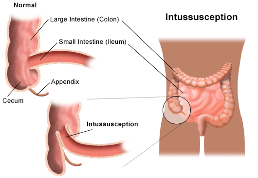 Illustration demonstrating intussusception