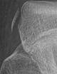ACL Trauma