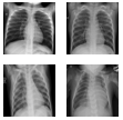 Pediatric pneumonia AI