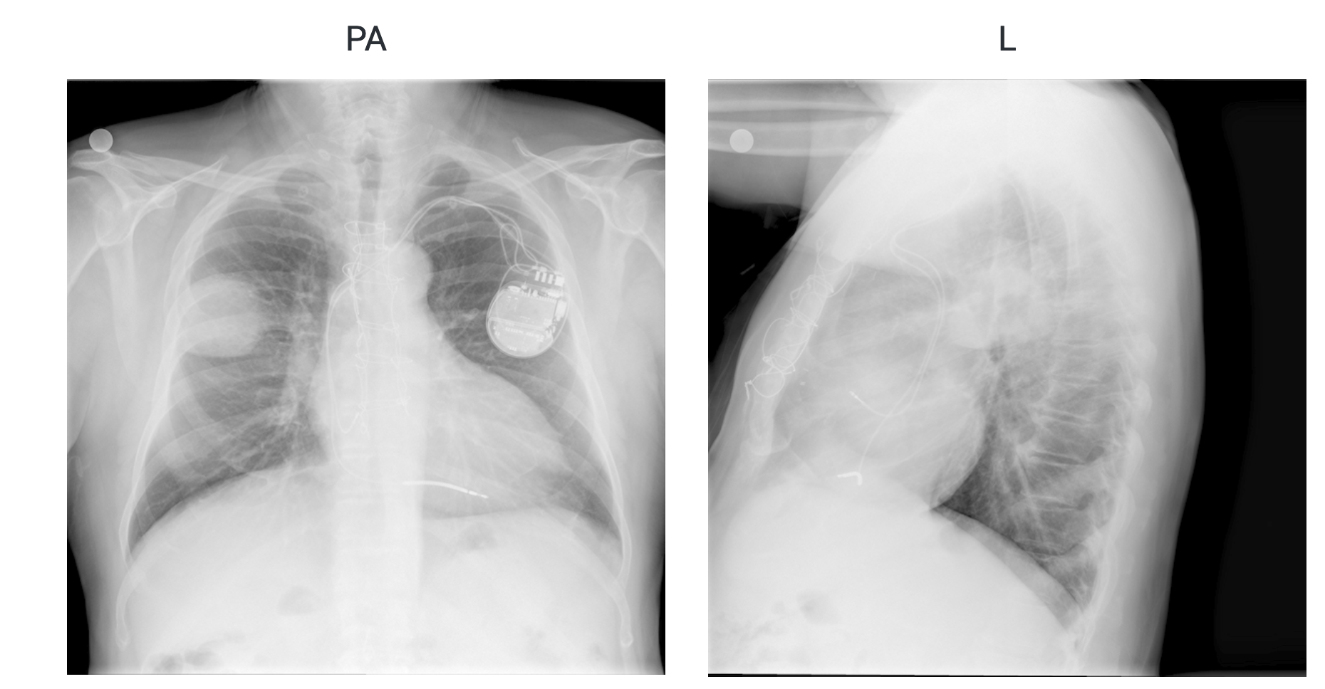 chest xray