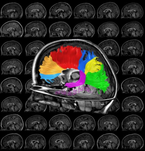 The corpus callosum in 48 children.