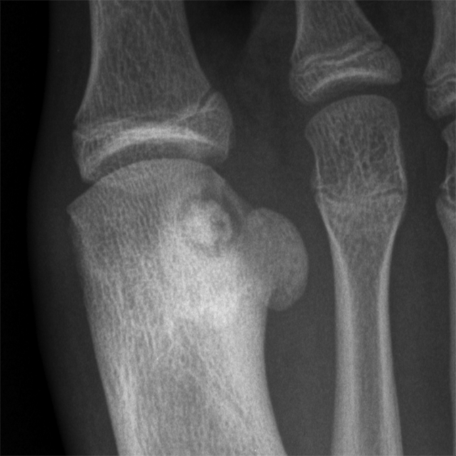 Central Calcification